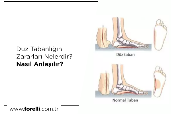 Düz Tabanlığın Zararları Nelerdir? Nasıl Anlaşılır?