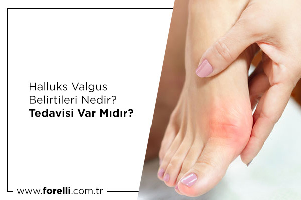 Halluks Valgus Belirtileri Nedir? Tedavisi Var Mıdır?