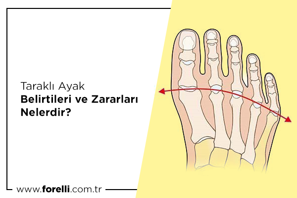 Taraklı Ayak Belirtileri ve Zararları Nelerdir?