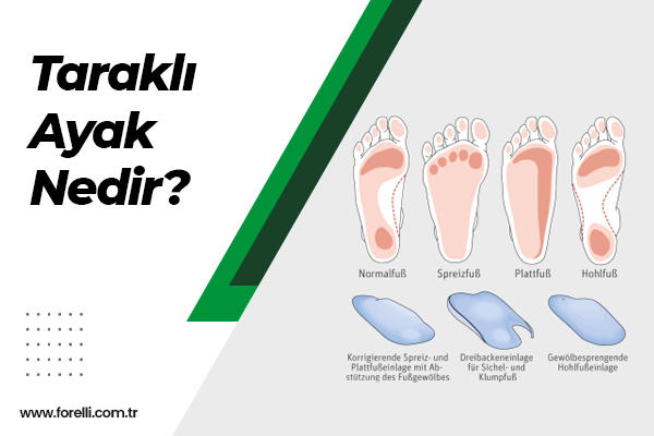 Taraklı Ayak Nedir?