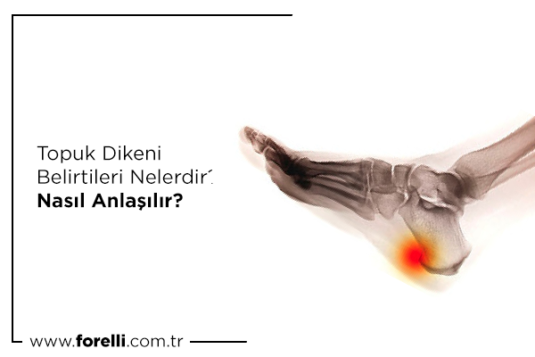 Topuk Dikeni Belirtileri Nelerdir? Nasıl Anlaşılır?